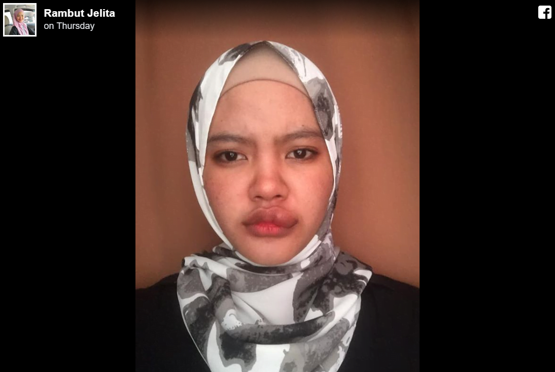 Dihinggap Serangga sewaktu Bawa Motosikal, Gadis Ini Kongsi Kisah Nya 3 3 2
