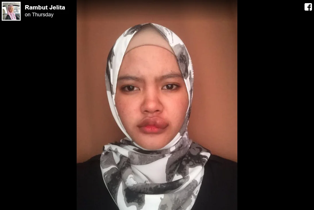 Dihinggap Serangga sewaktu Bawa Motosikal, Gadis Ini Kongsi Kisah Nya 3 3 2