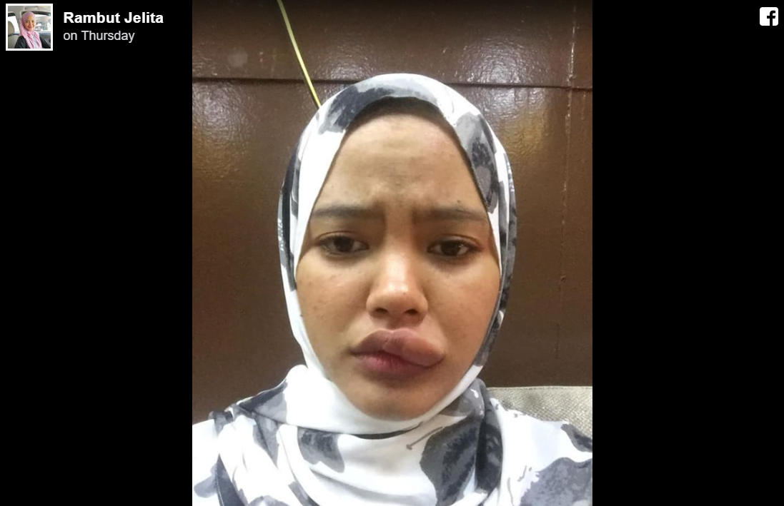 Dihinggap Serangga sewaktu Bawa Motosikal, Gadis Ini Kongsi Kisah Nya 4 4 2