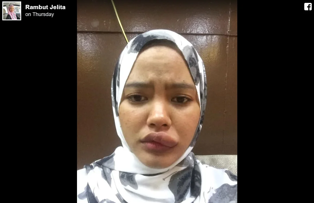 Dihinggap Serangga sewaktu Bawa Motosikal, Gadis Ini Kongsi Kisah Nya 4 4 2
