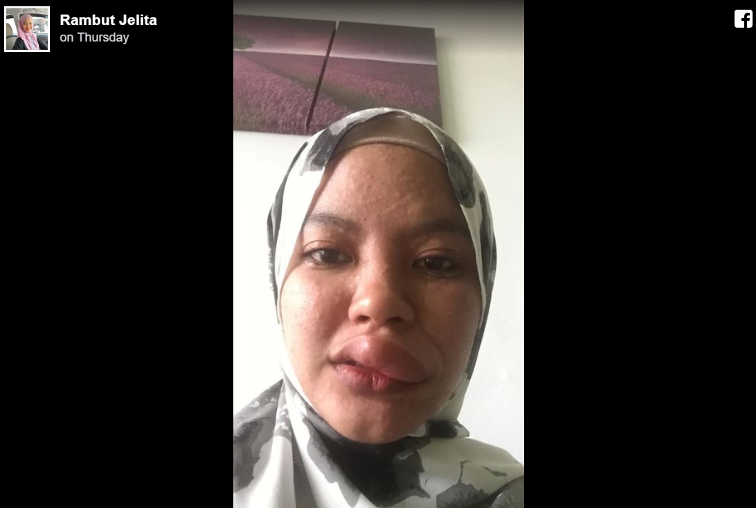 Dihinggap Serangga sewaktu Bawa Motosikal, Gadis Ini Kongsi Kisah Nya 5 5 1