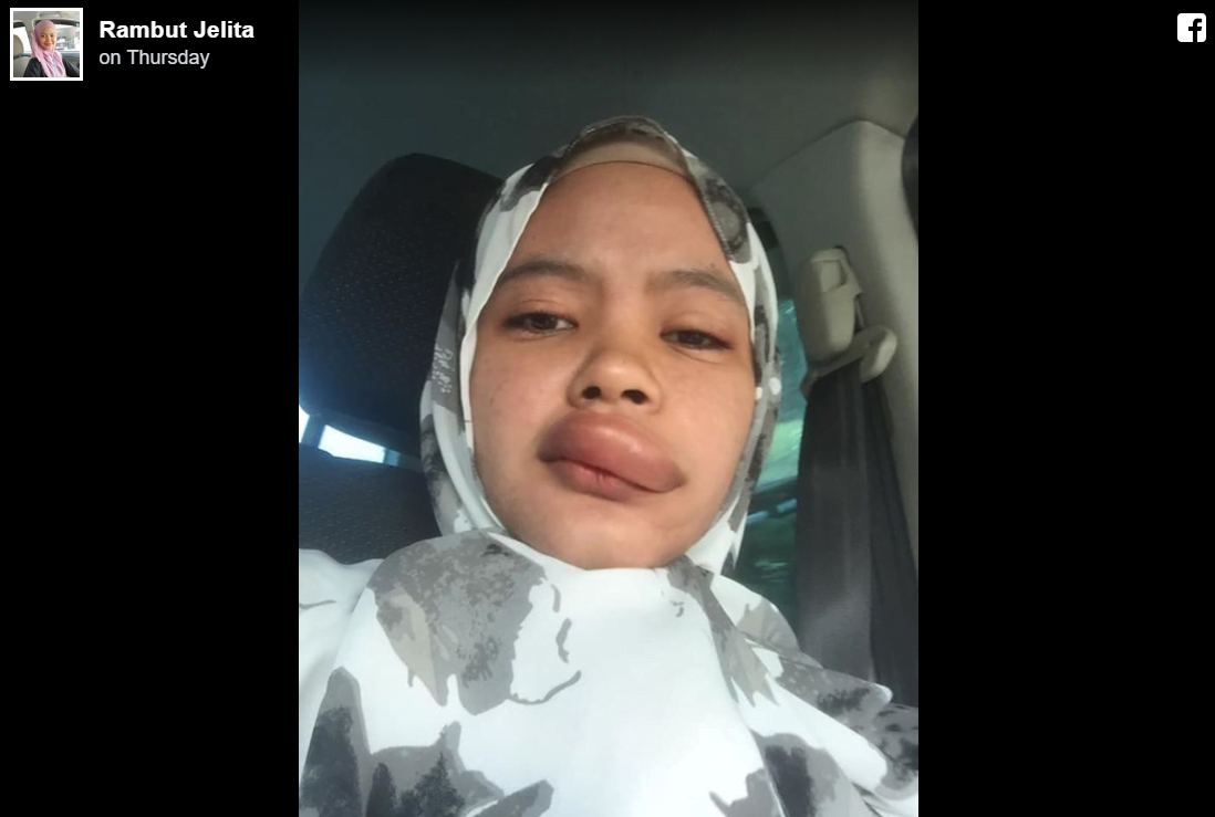 Dihinggap Serangga sewaktu Bawa Motosikal, Gadis Ini Kongsi Kisah Nya 6 6 1