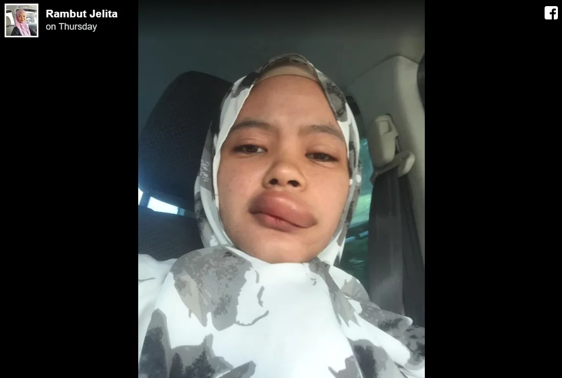 Dihinggap Serangga sewaktu Bawa Motosikal, Gadis Ini Kongsi Kisah Nya 6 6 1