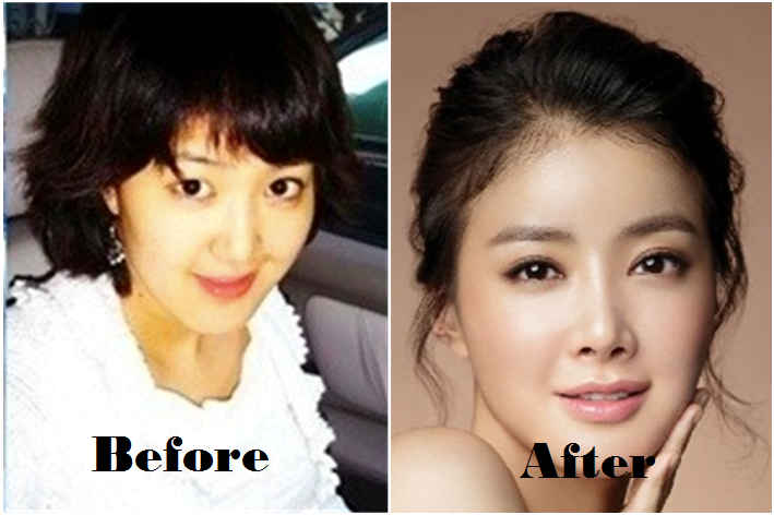 5 Artis Korea Mengaku Membuat Pembedahan Plastik 6 DE4DB82C 1934 4F03 88D3 C8996D749851